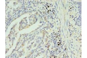 Immunohistochemistry of paraffin-embedded human lung cancer using ABIN7170235 at dilution of 1:100 (SLC35F5 抗体  (AA 122-242))