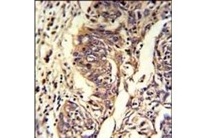 Formalin-fixed and paraffin-embedded human lung carcinoma reacted with KYNU Antibody (C-term), which was peroxidase-conjugated to the secondary antibody, followed by DAB staining. (KYNU 抗体  (C-Term))