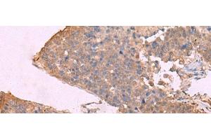 Immunohistochemistry of paraffin-embedded Human liver cancer tissue using KCNU1 Polyclonal Antibody at dilution of 1:45(x200) (KCNU1 抗体)