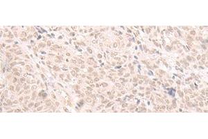 Immunohistochemistry of paraffin-embedded Human ovarian cancer tissue using HOOK2 Polyclonal Antibody at dilution of 1:30(x200) (HOOK2 抗体)