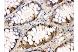 Anti- liver FABP Picoband antibody,IHC(P) IHC(P): Human Intestinal Cancer Tissue (FABP1 抗体  (N-Term))