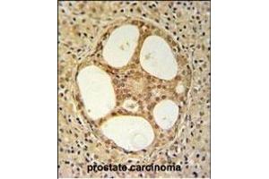 PRUNE Antibody (C-term) (ABIN653704 and ABIN2843021) IHC analysis in formalin fixed and paraffin embedded prostate carcinoma followed by peroxidase conjugation of the secondary antibody and DAB staining. (PRUNE 抗体  (C-Term))