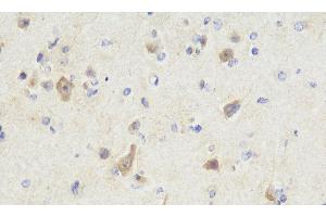 Immunohistochemistry analysis of paraffin-embedded Human brain cancer using NOS1 Polyclonal Antibody at dilution of 1:300. (NOS1 抗体)