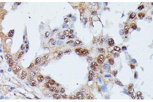 Immunohistochemistry of paraffin-embedded Human lung cancer using IGHMBP2 Polyclonal Antibody at dilution of 1:100 (40x lens). (IGHMBP2 抗体)