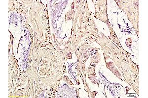 Formalin-fixed and paraffin embedded human colorectal cancer labeled with Anti-oxLDL Polyclonal Antibody, Unconjugated (ABIN733148) followed by conjugation to the secondary antibody and DAB staining (OxLDL 抗体)