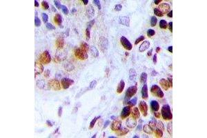Immunohistochemical analysis of Adenylate Kinase 6 staining in human prostate cancer formalin fixed paraffin embedded tissue section. (TAF9 抗体  (N-Term))