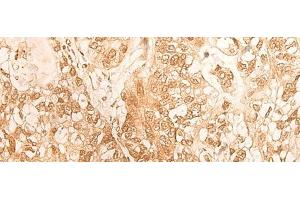 Immunohistochemistry of paraffin-embedded Human gastric cancer tissue using DBP Polyclonal Antibody at dilution of 1:25(x200) (DBP 抗体)