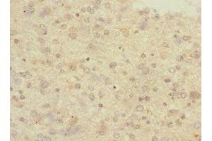 Immunohistochemistry of paraffin-embedded human glioma using ABIN7166554 at dilution of 1:100 (Protocadherin 1 抗体  (AA 515-715))