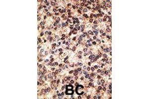 Formalin-fixed and paraffin-embedded human cancer tissue reacted with the primary antibody, which was peroxidase-conjugated to the secondary antibody, followed by DAB staining. (JAG2 抗体  (C-Term))