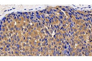 Detection of CTSK in Human Breast cancer Tissue using Polyclonal Antibody to Cathepsin K (CTSK) (Cathepsin K 抗体  (AA 54-317))