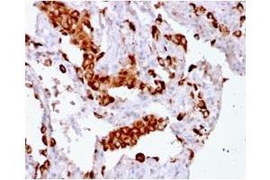 Formalin-fixed, paraffin-embedded human Lung Adenocarcinoma stained with Napsin A Mouse Recombinant Monoclonal Antibody (rNAPSA/1239). (Recombinant NAPSA 抗体  (AA 189-299))