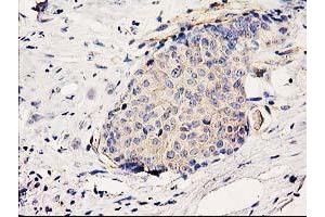 Immunohistochemical staining of paraffin-embedded Adenocarcinoma of Human breast tissue using anti-BCAR1 mouse monoclonal antibody. (BCAR1 抗体)