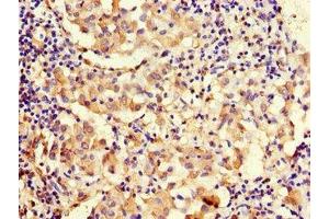 Immunohistochemistry of paraffin-embedded human lung cancer using ABIN7159746 at dilution of 1:100