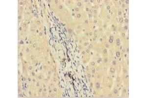 Immunohistochemistry of paraffin-embedded human liver cancer using ABIN7165631 at dilution of 1:100 (C11orf73 抗体  (AA 1-197))