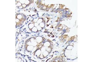 Immunohistochemistry of paraffin-embedded human colon carcinoma using IL1A Rabbit pAb (ABIN6129280, ABIN6142331, ABIN6142332 and ABIN6217051) at dilution of 1:100 (40x lens).