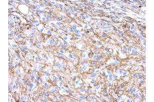 IHC-P Image Immunohistochemical analysis of paraffin-embedded U373 xenograft, using beta Actin, antibody at 1:500 dilution. (beta Actin 抗体  (N-Term))