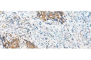 Immunohistochemistry of paraffin-embedded Human cervical cancer tissue using CAMSAP3 Polyclonal Antibody at dilution of 1:110(x200) (CAMSAP3 抗体)