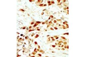 Formalin-fixed and paraffin-embedded human cancer tissue (breast carcinoma) reacted with the primary antibody, which was peroxidase-conjugated to the secondary antibody, followed by DAB staining. (DAPK2 抗体  (N-Term))
