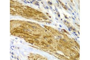 Immunohistochemistry of paraffin-embedded Human gastric cancer using CDK6 Polyclonal Antibody at dilution of 1:100 (40x lens). (CDK6 抗体)
