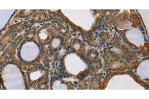 Immunohistochemistry of paraffin-embedded Human thyroid cancer using SCGB2A1 Polyclonal Antibody at dilution of 1:50 (SCGB2A1 抗体)