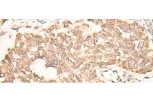 Immunohistochemistry of paraffin-embedded Human lung cancer tissue using EMSY Polyclonal Antibody at dilution of 1:25(x200) (EMSY 抗体)
