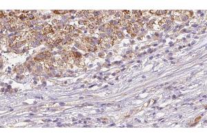 ABIN6272645 at 1/100 staining Human liver cancer tissue by IHC-P. (CD235a/GYPA 抗体  (Internal Region))