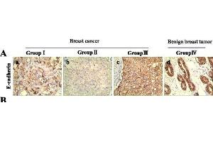 Immunohistochemistry (IHC) image for anti-Cadherin 1, Type 1, E-Cadherin (Epithelial) (CDH1) (AA 401-500) antibody (ABIN1387847)