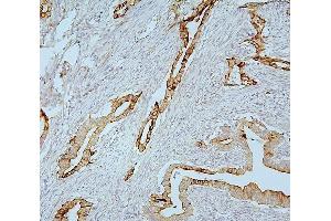 IHC analysis of MMP1 using anti-MMP1 antibody (ABIN7599873). (MMP1 抗体  (AA 124-469))