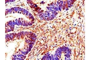 Immunohistochemistry of paraffin-embedded human ovarian cancer using ABIN7170549 at dilution of 1:100 (SMS 抗体  (AA 16-191))