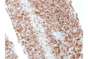 Formalin-fixed, paraffin-embedded human Melanoma stained with CD63 Mouse Monoclonal Antibody (LAMP3/2881) (CD63 抗体  (AA 100-197))