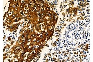 ABIN6262729 and ABIN6278925 at 1/100 staining human esophageal cancer by IHC-P. (Keratin 6 抗体  (C-Term))