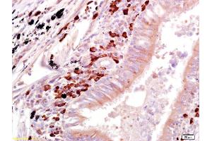 Formalin-fixed and paraffin embedded human lung carcinoma labeled with Anti-OAS1 Polyclonal Antibody, Unconjugated (ABIN671931) at 1:200 followed by conjugation to the secondary antibody and DAB staining (OAS1 抗体)