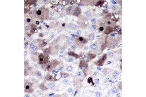 Immunohistochemical analysis of PSMD8 staining in human liver cancer formalin fixed paraffin embedded tissue section. (PSMD8 抗体)