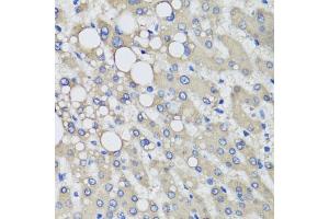 Immunohistochemistry of paraffin-embedded human liver injury using PRODH antibody (ABIN5973448) at dilution of 1/100 (40x lens). (PRODH 抗体)