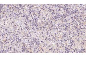 ABIN6273121 at 1/100 staining Human lymph cancer tissue by IHC-P. (Hemoglobin, epsilon 1 (HBe1) 抗体)