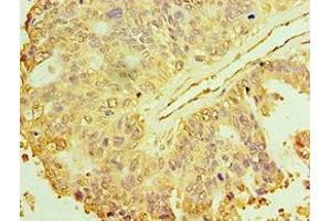 Immunohistochemistry of paraffin-embedded human endometrial cancer using ABIN7150706 at dilution of 1:100 (MAP2K3 抗体  (AA 1-170))