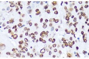 Immunohistochemistry of paraffin-embedded Human liver cancer using Phospho-ABL1(Y245) Polyclonal Antibody at dilution of 1:100 (40x lens). (ABL1 抗体  (pTyr245))