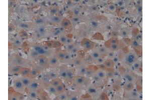 DAB staining on IHC-P; Samples: Human Liver cancer Tissue (PAD4 抗体  (AA 1-300))
