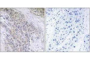 Immunohistochemistry analysis of paraffin-embedded human breast carcinoma, using BCL-2 (Phospho-Thr56) Antibody. (Bcl-2 抗体  (pThr56))