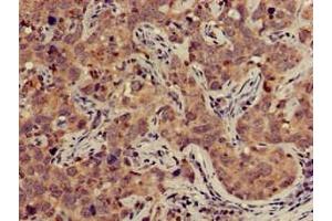 Immunohistochemistry of paraffin-embedded human pancreatic cancer using ABIN7149950 at dilution of 1:100 (TFB2M 抗体  (AA 30-108))