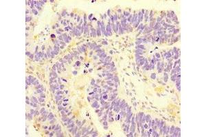 Immunohistochemistry of paraffin-embedded human ovarian cancer using ABIN7170745 at dilution of 1:100 (SAMD7 抗体  (AA 1-300))