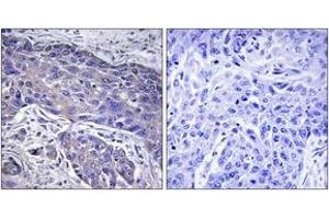 Immunohistochemistry analysis of paraffin-embedded human lung carcinoma tissue, using POFUT1 Antibody. (POFUT1 抗体  (AA 331-380))