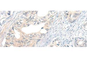 Immunohistochemistry of paraffin-embedded Human gastric cancer tissue using NOG Polyclonal Antibody at dilution of 1:50(x200) (NOG 抗体)