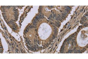 Immunohistochemistry of paraffin-embedded Human colon cancer tissue using MYO18B Polyclonal Antibody at dilution 1:50 (MYO18B 抗体)