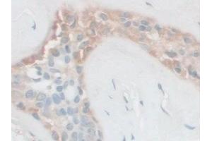 Detection of FSTL1 in Human Breast cancer Tissue using Polyclonal Antibody to Follistatin Like Protein 1 (FSTL1) (FSTL1 抗体  (AA 21-308))