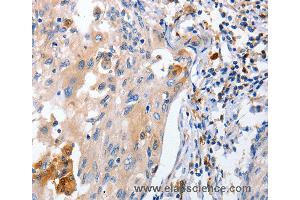 Immunohistochemistry of Human cervical cancer using IL18 Polyclonal Antibody at dilution of 1:100 (IL-18 抗体)
