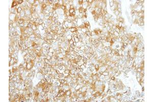 IHC-P Image Immunohistochemical analysis of paraffin-embedded BT474 xenograft, using Calpain 1, antibody at 1:500 dilution. (CAPN1 抗体)