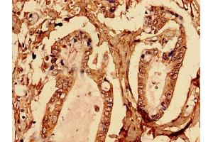 Immunohistochemistry analysis of human pancreatic cancer using ABIN7145580 at dilution of 1:100 (Biglycan 抗体  (AA 38-300))