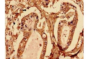 Immunohistochemistry analysis of human pancreatic cancer using ABIN7145580 at dilution of 1:100