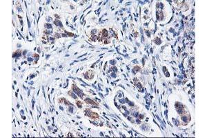 Immunohistochemical staining of paraffin-embedded Carcinoma of Human lung tissue using anti-HARS2 mouse monoclonal antibody. (HARS2 抗体)